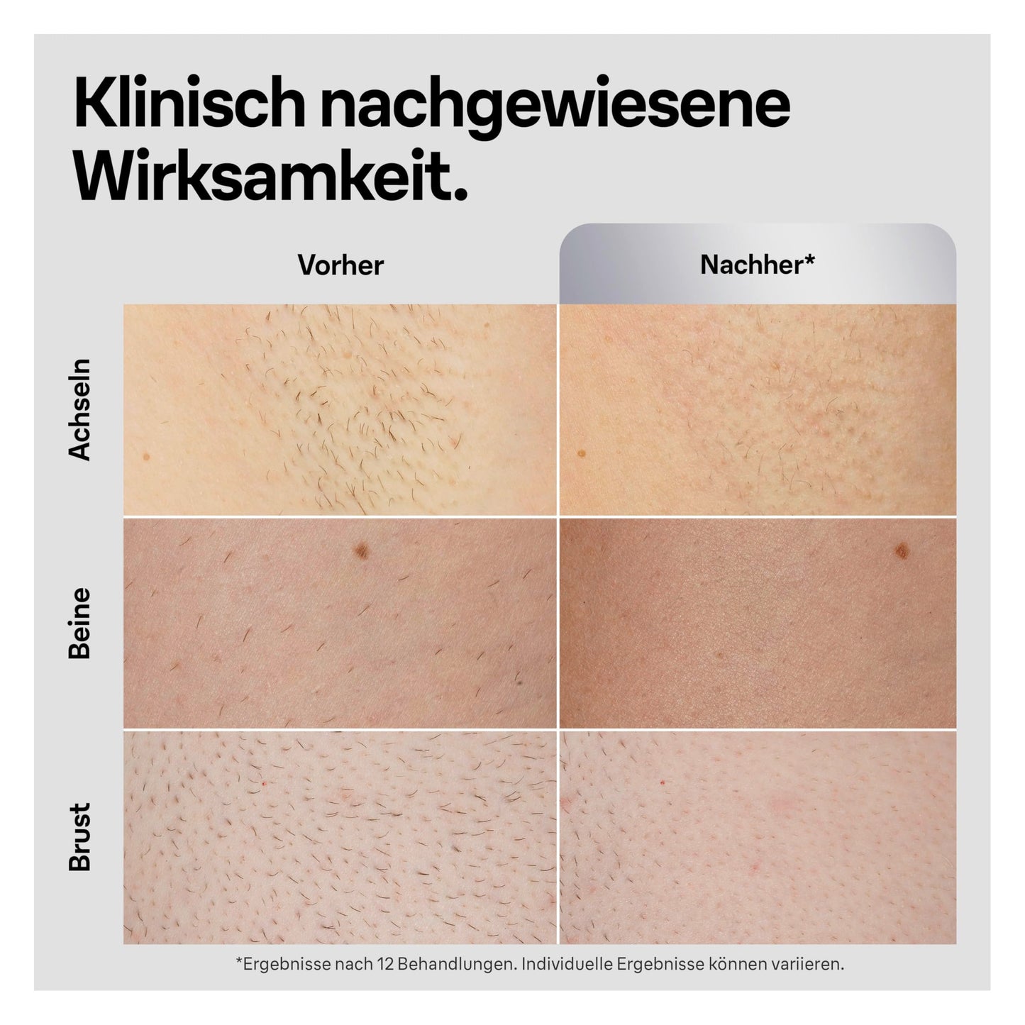 Braun IPL Silk Expert Pro 5 Haarentfernungsgerät Damen, sichtbare Haarentfernung, Designed In Germany, Venus Rasierer, 3 Aufsätze, Alternative zu Laser Haarentfernung, PL5262, weiß/gold